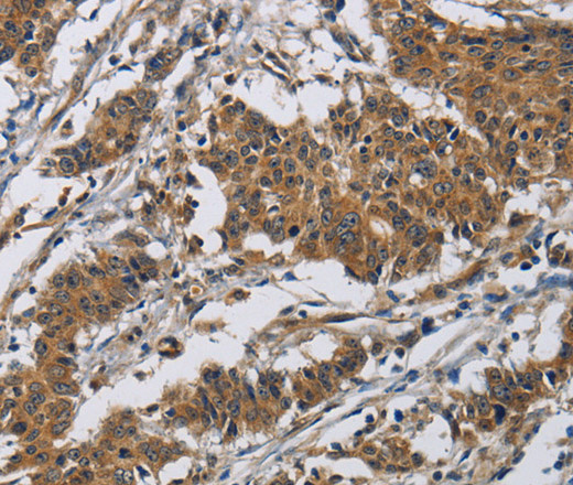 Immunohistochemistry of paraffin-embedded Human gastric cancer tissue using Claudin 8 Polyclonal Antibody at dilution 1:50