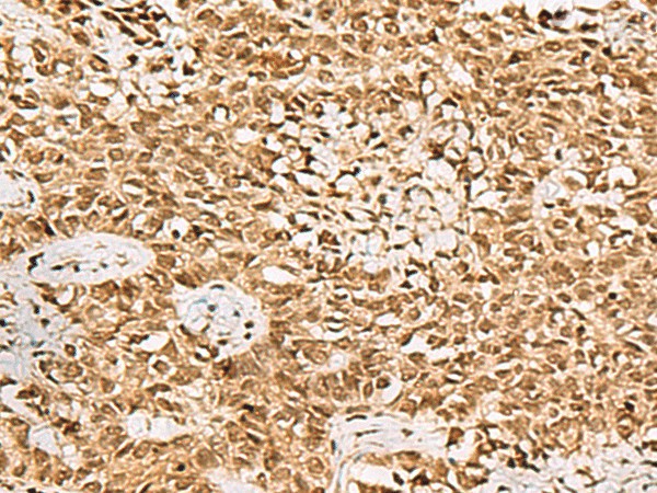 Immunohistochemistry of paraffin-embedded Human ovarian cancer tissue  using LRRC2 Polyclonal Antibody at dilution of 1:70(?200)