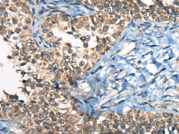 Immunohistochemistry of paraffin-embedded Human ovarian cancer tissue  using CDKL4 Polyclonal Antibody at dilution of 1:45(?200)