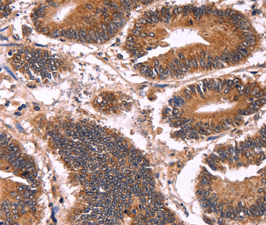 Immunohistochemistry of paraffin-embedded Human colon cancer tissue using CCDC106 Polyclonal Antibody at dilution 1:60