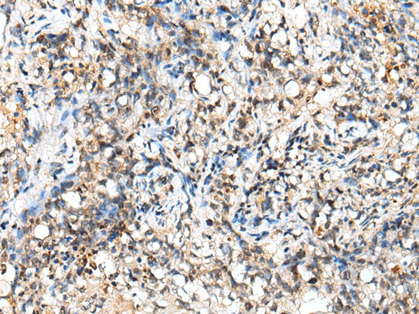 Immunohistochemistry of paraffin-embedded Human lung cancer tissue  using NUDT18 Polyclonal Antibody at dilution of 1:40(?200)