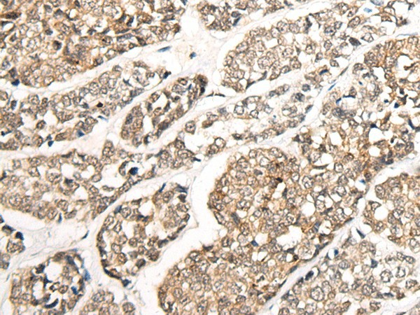 Immunohistochemistry of paraffin-embedded Human esophagus cancer tissue  using CCDC181 Polyclonal Antibody at dilution of 1:50(?200)