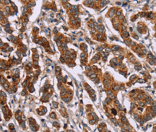 Immunohistochemistry of paraffin-embedded Human breast cancer tissue using ID2 Polyclonal Antibody at dilution 1:30