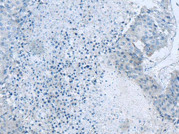 Immunohistochemistry of paraffin-embedded Human liver cancer tissue  using GLS Polyclonal Antibody at dilution of 1:60(?200)