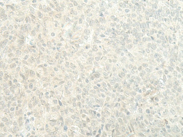 Immunohistochemistry of paraffin-embedded Human ovarian cancer tissue  using ESRP2 Polyclonal Antibody at dilution of 1:95(?200)