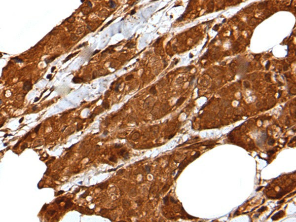 Immunohistochemistry of paraffin-embedded Human breast cancer tissue  using LIPG Polyclonal Antibody at dilution of 1:50(?200)