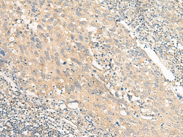 Immunohistochemistry of paraffin-embedded Human cervical cancer tissue  using CHP1 Polyclonal Antibody at dilution of 1:25(?200)