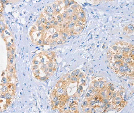 Immunohistochemistry of paraffin-embedded Human cervical cancer tissue using BRCA1 Polyclonal Antibody at dilution 1:35