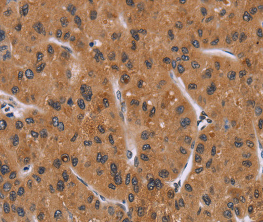 Immunohistochemistry of paraffin-embedded Human liver cancer using PPIB Polyclonal Antibody at dilution of 1:40