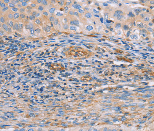 Immunohistochemistry of paraffin-embedded Human cervical cancer tissue using NRG4 Polyclonal Antibody at dilution 1:60