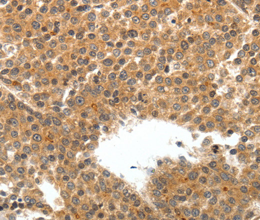 Immunohistochemistry of paraffin-embedded Human liver cancer tissue using TEK Polyclonal Antibody at dilution 1:50