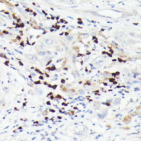 Immunohistochemistry of paraffin-embedded human liver cancer using MMP8 Polyclonal Antibody at dilution of 1:150 (40x lens).Perform high pressure antigen retrieval with 10 mM citrate buffer pH 6.0 before commencing with IHC staining protocol.