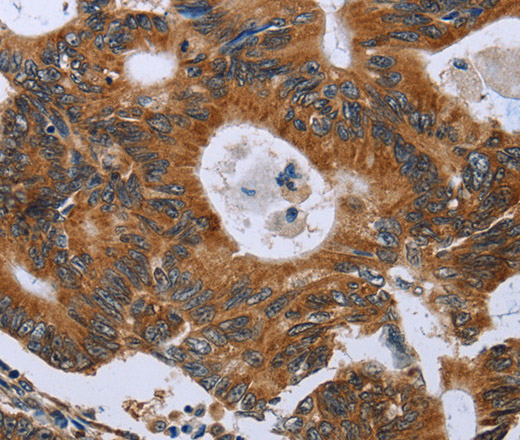 Immunohistochemistry of paraffin-embedded Human colon cancer using GH2 Polyclonal Antibody at dilution of 1:40