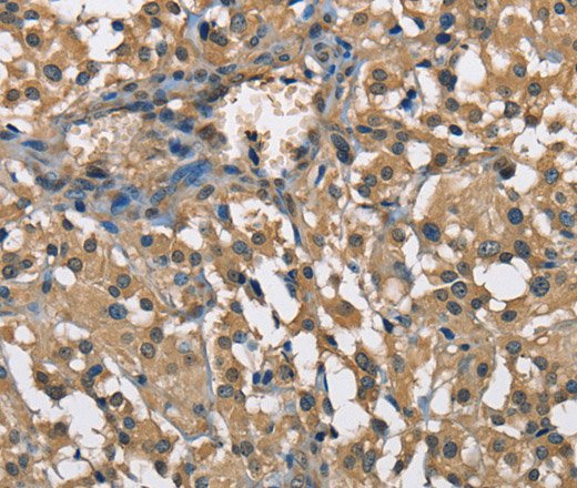 Immunohistochemistry of paraffin-embedded Human thyroid cancer using ENO1 Polyclonal Antibody at dilution of 1:60