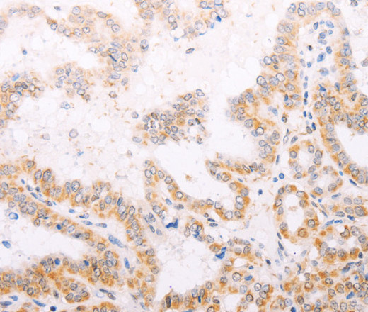 Immunohistochemistry of paraffin-embedded Human thyroid cancer using TYR Polyclonal Antibody at dilution of 1:30