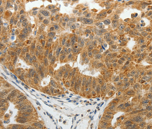 Immunohistochemistry of paraffin-embedded Human ovarian cancer tissue using SOCS7 Polyclonal Antibody at dilution 1:30