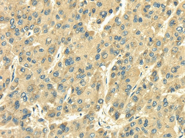 Immunohistochemistry of paraffin-embedded Human liver cancer tissue using SDF4 Polyclonal Antibody at dilution 1:35