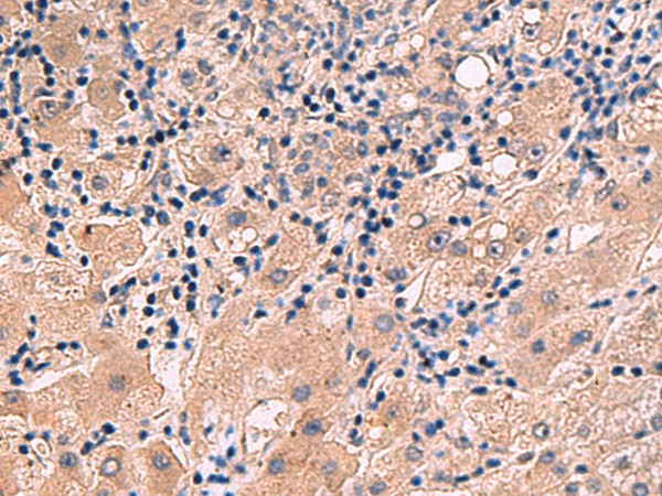 Immunohistochemistry of paraffin-embedded Human liver cancer tissue  using INSM2 Polyclonal Antibody at dilution of 1:35(?200)