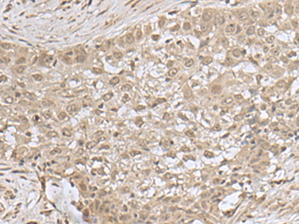 Immunohistochemistry of paraffin-embedded Human esophagus cancer tissue  using NEUROG3 Polyclonal Antibody at dilution of 1:55(?200)