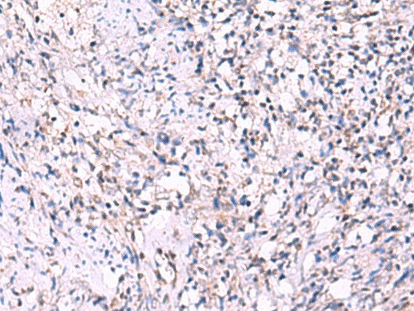 Immunohistochemistry of paraffin-embedded Human cervical cancer tissue  using ECSIT Polyclonal Antibody at dilution of 1:70(?200)