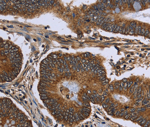 Immunohistochemistry of paraffin-embedded Human colon cancer tissue using FHIT Polyclonal Antibody at dilution 1:30