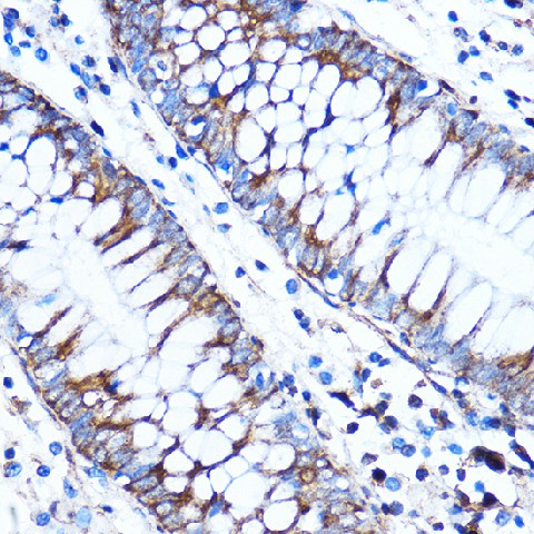 Immunohistochemistry of paraffin-embedded Human colon using CTGF Polyclonal Antibody at dilution of 1:100 (40x lens).Perform microwave antigen retrieval with 10 mM PBS buffer pH 7.2 before commencing with IHC staining protocol.