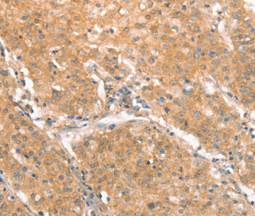 Immunohistochemistry of paraffin-embedded Human gastric cancer tissue using CXCR4 Polyclonal Antibody at dilution 1:50