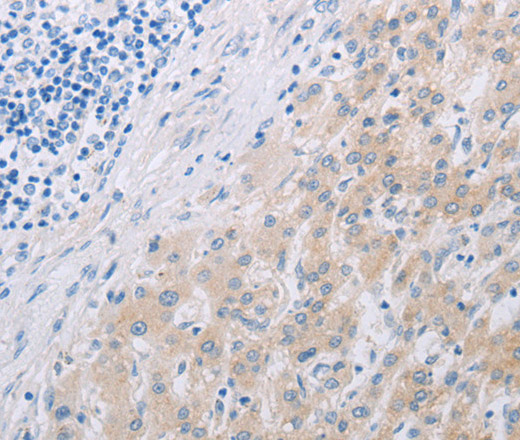 Immunohistochemistry of paraffin-embedded Human liver cancer using PFN2 Polyclonal Antibody at dilution of 1:30