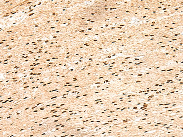 Immunohistochemistry of paraffin-embedded Human colorectal cancer tissue  using HIST1H1D Polyclonal Antibody at dilution of 1:55(?200)