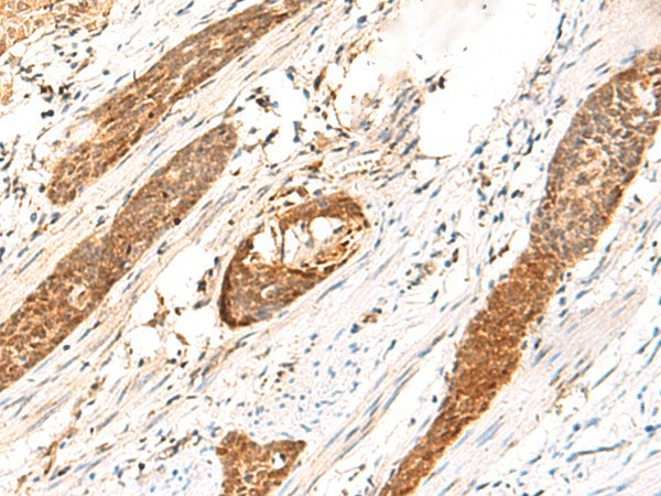 Immunohistochemistry of paraffin-embedded Human esophagus cancer tissue  using DCAF10 Polyclonal Antibody at dilution of 1:130(?200)