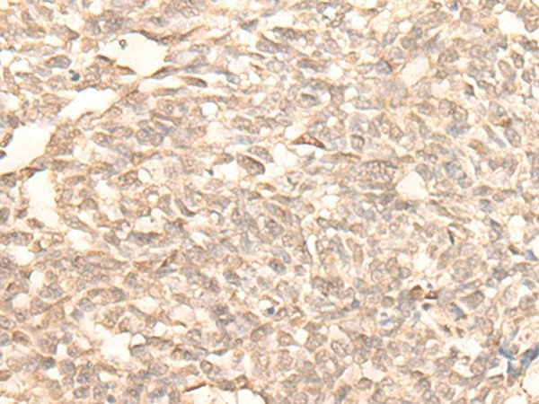 Immunohistochemistry of paraffin-embedded Human lung cancer tissue  using RAD23B Polyclonal Antibody at dilution of 1:25(?200)