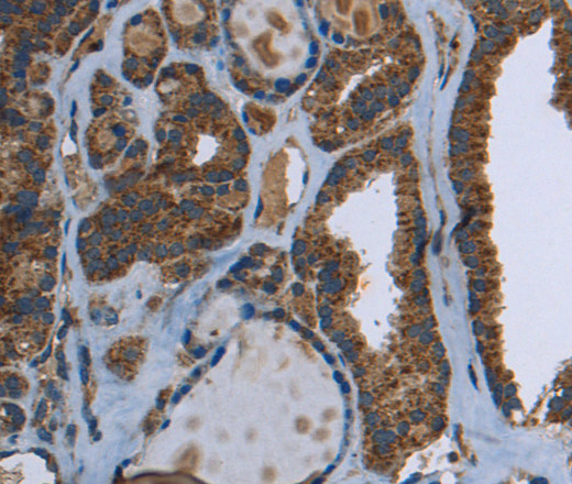 Immunohistochemistry of paraffin-embedded Human thyroid cancer using GCK Polyclonal Antibody at dilution of 1:40