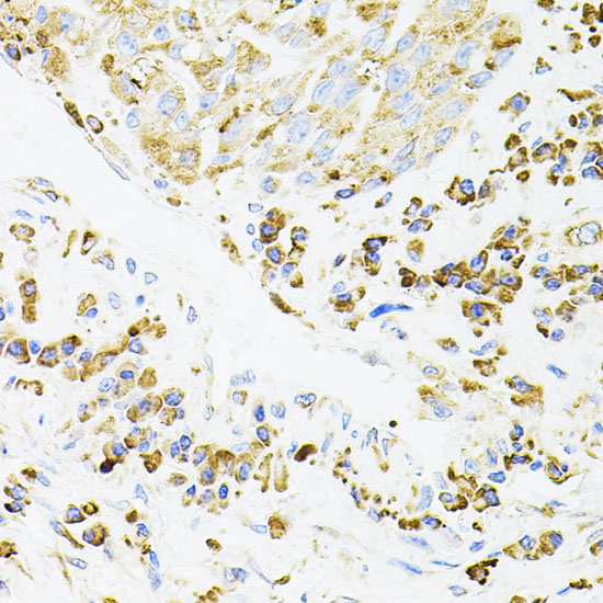 Immunohistochemistry of paraffin-embedded Human lung cancer using IRF1 Polyclonal Antibody