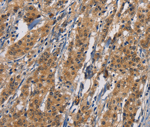 Immunohistochemistry of paraffin-embedded Human gastric cancer tissue using PIKFYVE Polyclonal Antibody at dilution 1:50