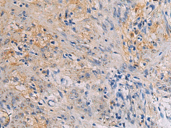 Immunohistochemistry of paraffin-embedded Human gastric cancer tissue  using CHST3 Polyclonal Antibody at dilution of 1:30(?200)