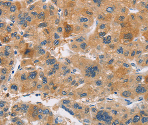 Immunohistochemistry of paraffin-embedded Human liver cancer using CYP4A11 Polyclonal Antibody at dilution of 1:30