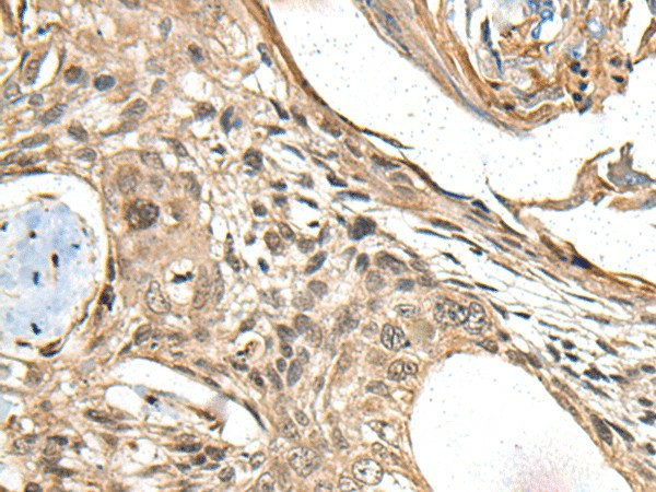 Immunohistochemistry of paraffin-embedded Human esophagus cancer tissue  using MAPK4 Polyclonal Antibody at dilution of 1:35(?200)