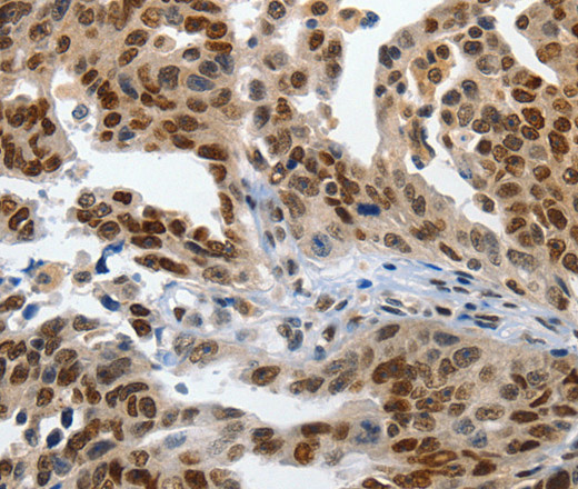 Immunohistochemistry of paraffin-embedded Human ovarian cancer using KLF5 Polyclonal Antibody at dilution of 1:120