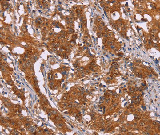 Immunohistochemistry of paraffin-embedded Human gasrtic cancer tissue using DCTN6 Polyclonal Antibody at dilution 1:40