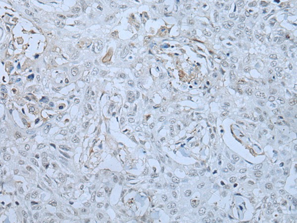 Immunohistochemistry of paraffin-embedded Human lung cancer tissue  using HUWE1 Polyclonal Antibody at dilution of 1:30(?200)