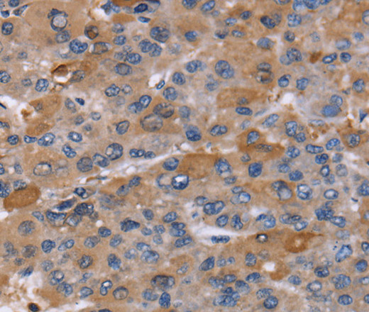 Immunohistochemistry of paraffin-embedded Human liver cancer using NCF2 Polyclonal Antibody at dilution of 1:60