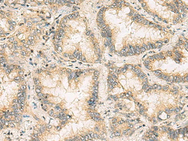 Immunohistochemistry of paraffin-embedded Human lung cancer tissue  using NANP Polyclonal Antibody at dilution of 1:65(?200)