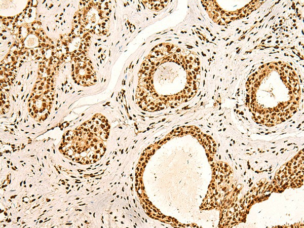 Immunohistochemistry of paraffin-embedded Human breast cancer tissue  using ILF3 Polyclonal Antibody at dilution of 1:60(?200)