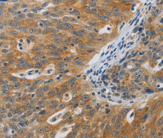 Immunohistochemistry of paraffin-embedded Human ovarian cancer using F2R Polyclonal Antibody at dilution of 1:40