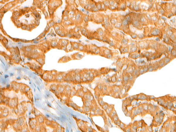 Immunohistochemistry of paraffin-embedded Human thyroid cancer tissue  using CEP72 Polyclonal Antibody at dilution of 1:40(?200)