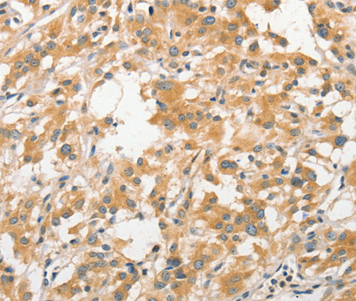 Immunohistochemistry of paraffin-embedded Human thyroid cancer tissue using APC5 Polyclonal Antibody at dilution 1:30