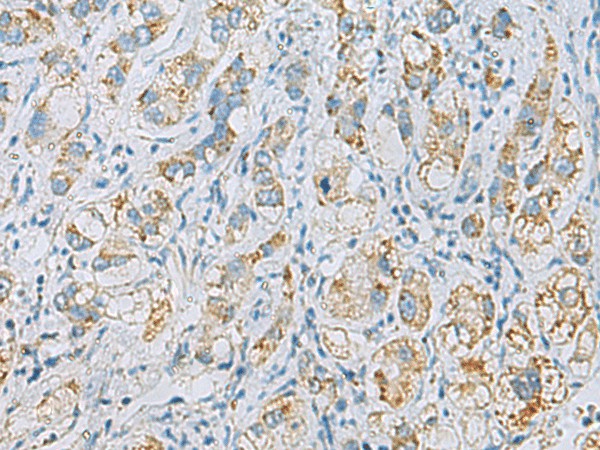 Immunohistochemistry of paraffin-embedded Human liver cancer tissue  using PLA2G15 Polyclonal Antibody at dilution of 1:65(?200)