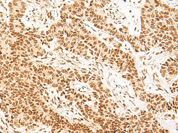 Immunohistochemistry of paraffin-embedded Human ovarian cancer tissue  using NHP2 Polyclonal Antibody at dilution of 1:55(?200)