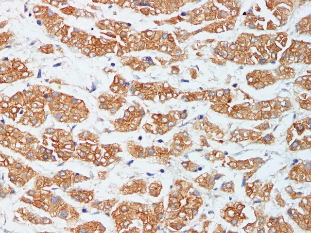 Immunohistochemistry of paraffin-embedded Human liver cancer using CK-18 Polyclonal Antibody at dilution of 1:200