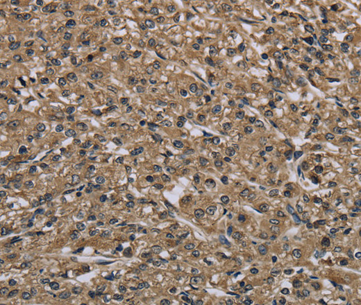 Immunohistochemistry of paraffin-embedded Human prostate cancer tissue using MYO18B Polyclonal Antibody at dilution 1:50